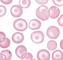 <p><span style="font-family: "Times New Roman", serif">RBCs with a central bullseye appearance; seen in liver disease, thalassemia, and hemoglobinopathies.</span></p>