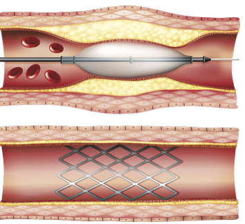 <p>balloon inserted to widen vessel and stent deployed&nbsp;</p>
