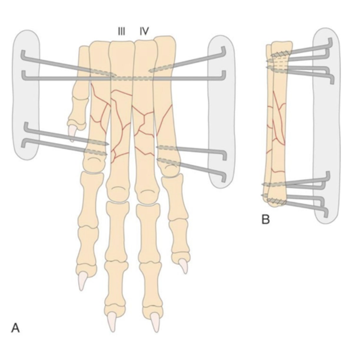 <p>How can you provide rigid stabilization of comminuted metatarsal fractures or open wound fractures?</p>