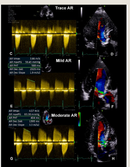 <p>Coexistent pressure and volume overload</p><p>Patients with severe mixed AS/AR have</p><p>smaller LV dimensions and volumes then a</p><p>severe aortic regurgitation patient</p>