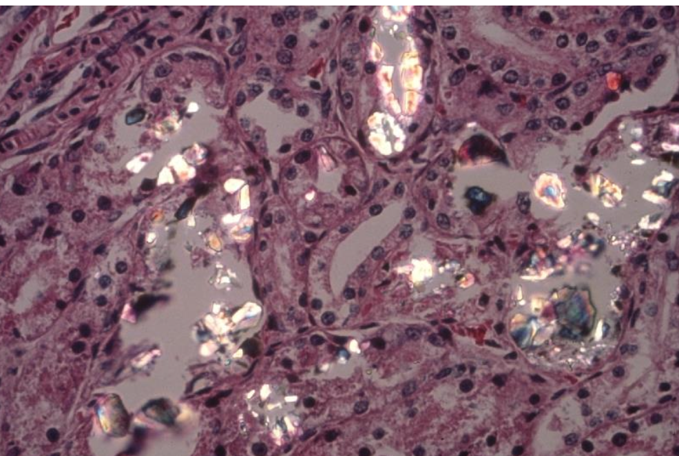 <p>proximal tubule degeneration and necrosis, birefringent calcium oxalate monohydrate crystals within renal tubules (brain, GIT vasculature) </p>