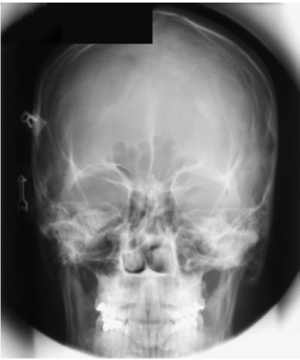 <p>This is a PA 15° Caldwell projection.</p><p>Repeatable errors (two)—</p><p>Criterion 1: Anatomy demonstrated: Patient identification marker (analog cassette) and side marker are obscuring skull. </p><p>Criterion 5: Anatomic side markers: Anatomic side marker is evident but placed over skull; patient identification marker is over upper right cranium.</p>