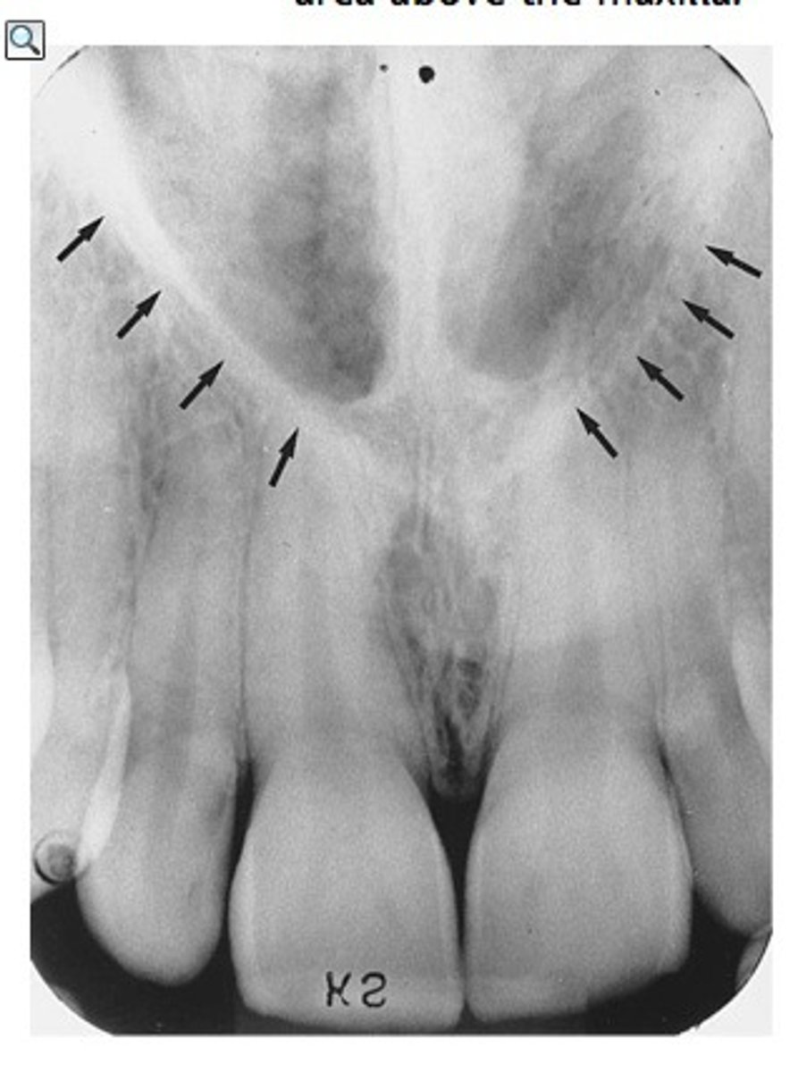 <p>Radiolucent area above maxillary incisors</p>