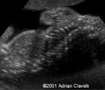<ol><li><p>What is abnormal about this image?</p></li><li><p>This finding can be associated with what pathology?</p></li></ol><p></p>