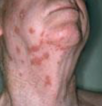 <p>What is Varicella-Zoster Shingles (VZV/HHV3)?</p>
