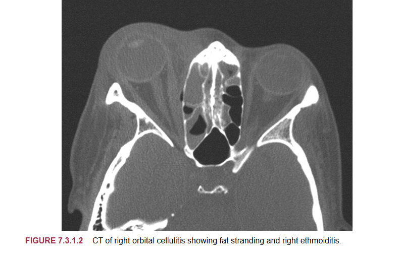 <p>what exam is done with those with orbital cellulitis </p>