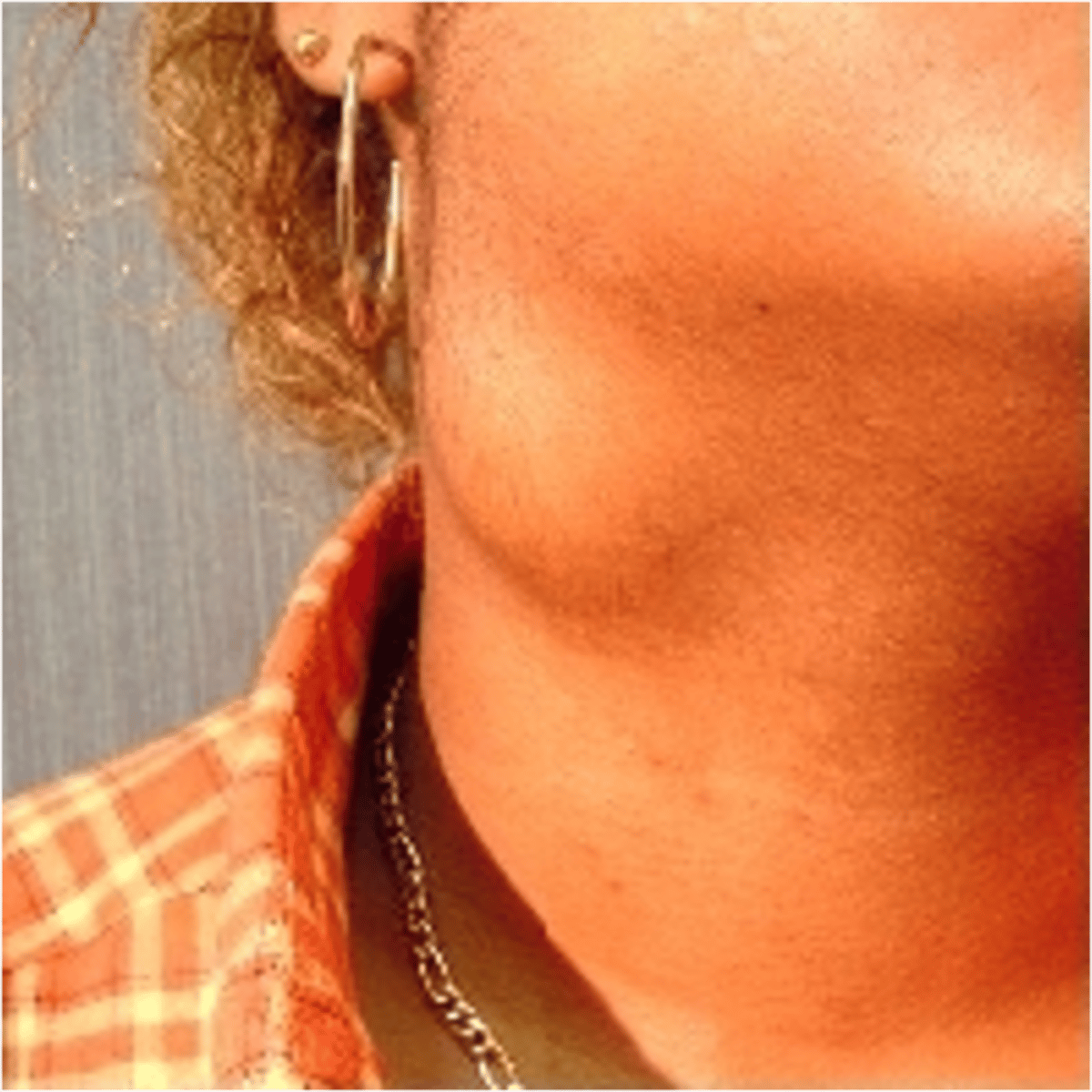 <p>________________:</p><p>•Solid lesion with elevation &amp; depth</p><p>•Usually involves epidermis &amp; dermis, possibly SC tissue</p><p>•&gt; 2 cm in diameter</p><p>•+/ - pigmentation</p>