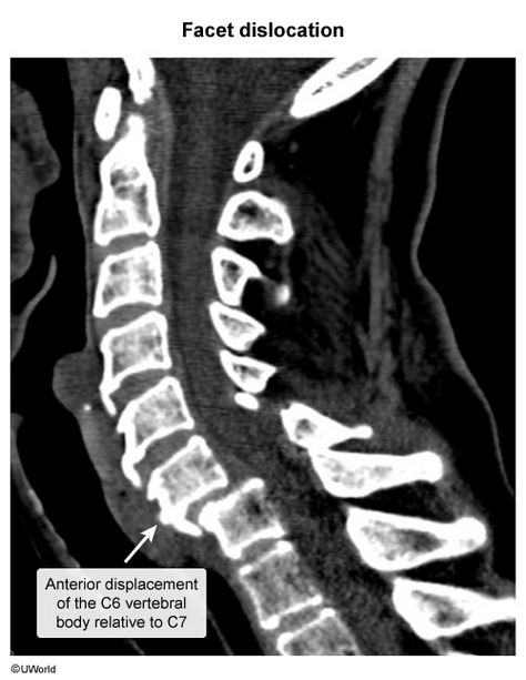 <p>typically occurs with forced flexion of cervical spine (ie, falling onto flexed neck) → single facet disloicated, radiculopathy</p><p></p><p>this case is c7 radiculopathy</p>