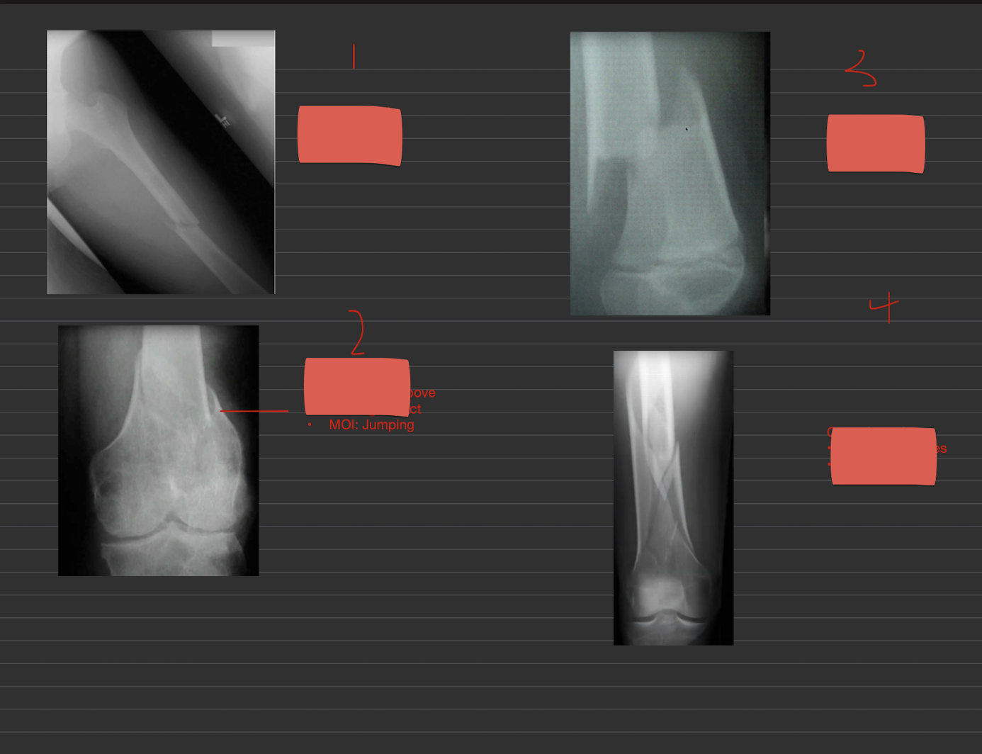 <p>Name these fractures:</p><ul><li><p>1</p></li><li><p>2</p></li><li><p>3</p></li><li><p>4</p></li></ul><p></p>