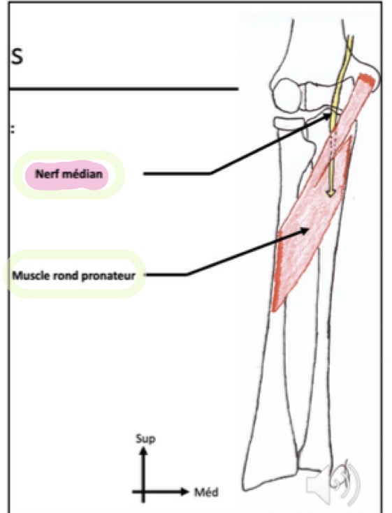 <p>Le nerf médian traverse le muscle d’arrière en avant</p>