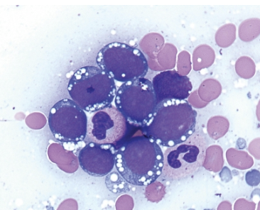<p>what cells have the following characteristics:</p><ul><li><p>medium to large in size</p></li><li><p>finely clumped chromatin</p></li><li><p>deeply basophilic cytoplasm with distinct vacuoles </p></li><li><p>BM and lymph biopsies</p><ul><li><p>“starry sky” appearance </p><ul><li><p>interspersed tangible body macrophages suspended in a “sea” of malignant cells </p></li></ul></li></ul></li></ul><p></p>