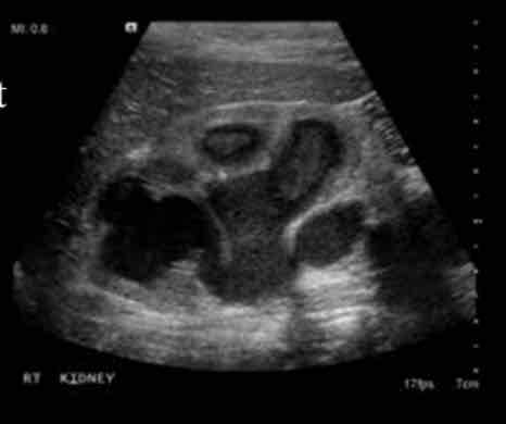 <p>What is <span>the presence of pus in collection system, associated with infection secondary to renal obstruction?</span><br><span>Sonographic appearance</span><br><span>• hyperechoic debris in dilated renal collecting system</span><br><span>• Drainage required for treatmen</span></p>