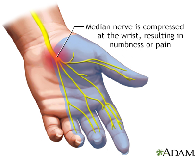 <p>-Compression of median nerve</p><p>-Burning, tingling, pins &amp; needles, numbness at night</p><p>-Positive Tinel’s sign</p><p>-Common in pregnancy, DM, and RA</p>