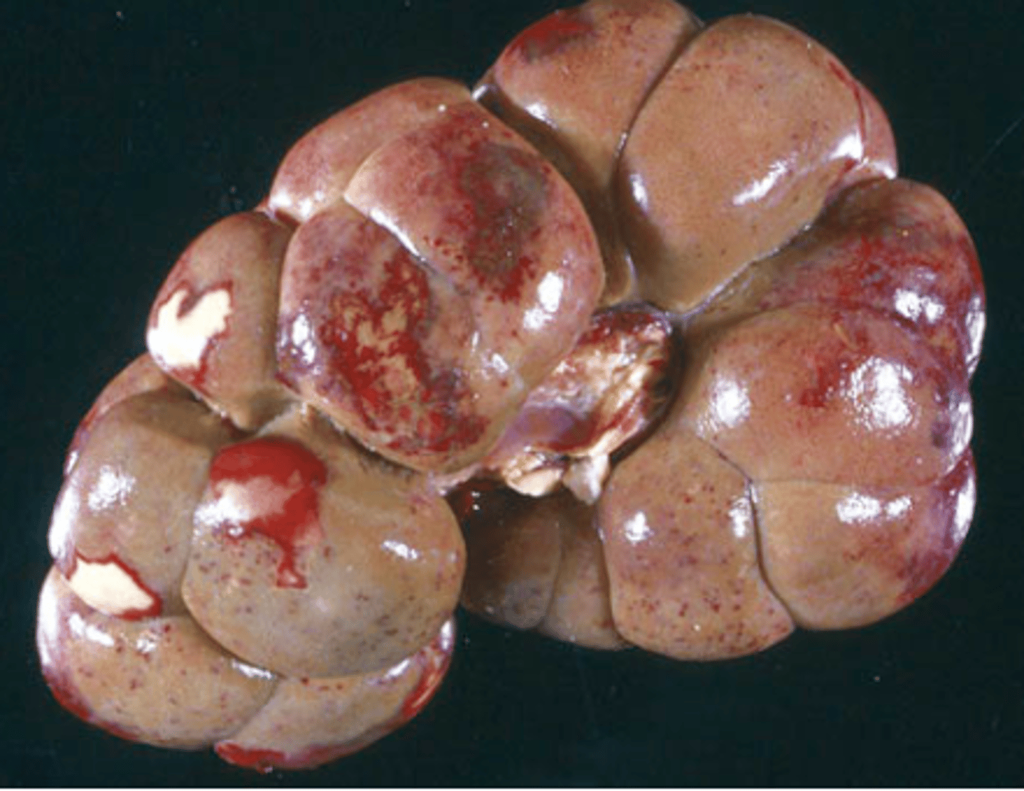 <p>What type of necrosis is being shown in this image?</p>