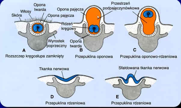 <p>przepuklina oponowo-rdzeniowa</p>