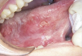 <p>Where would you find oral squamous cell carcinoma?</p>