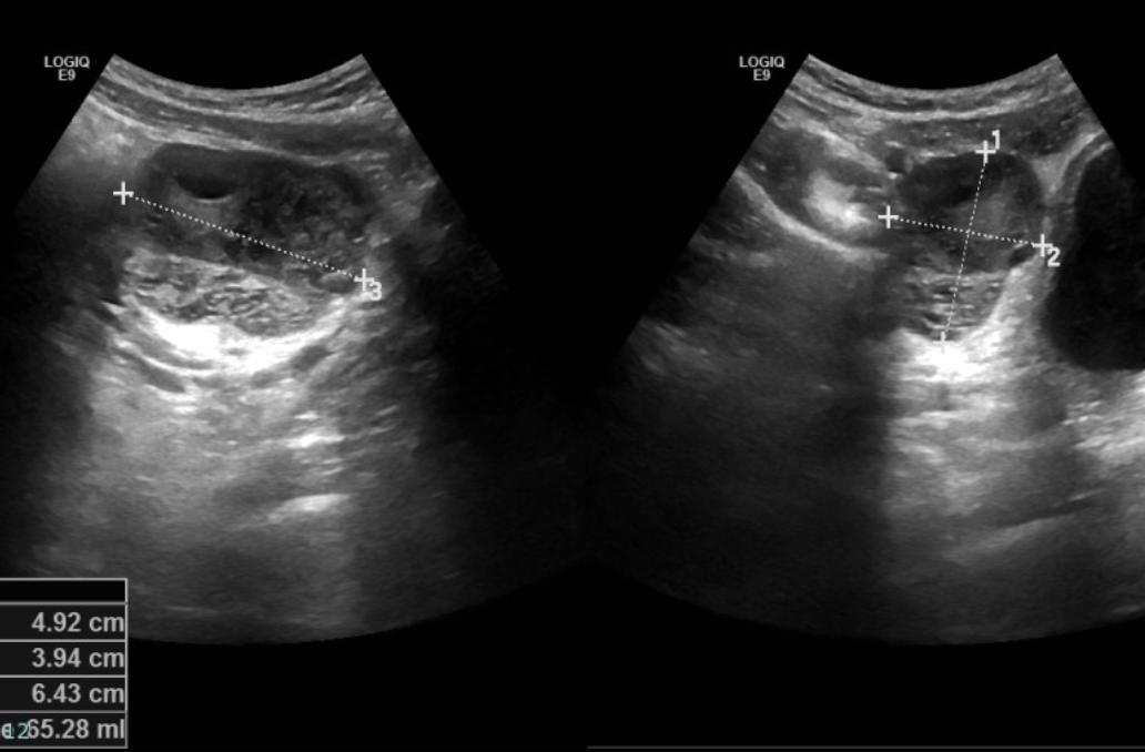 <p>Diagnostics for Adnexal torsion</p>