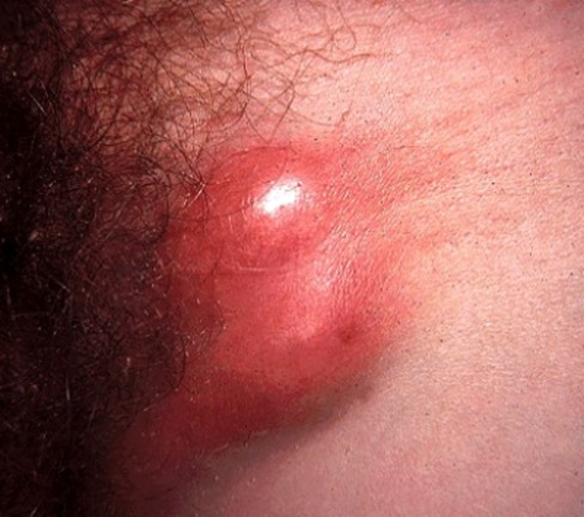 <p>caused by : c. trichromats</p><p>symptoms : </p><ul><li><p>infecting lymphoid tissue </p></li><li><p>forms buboes  </p></li><li><p>Intercellular </p></li><li><p>has two forms </p><ul><li><p>elementary </p></li><li><p>reticulate </p></li></ul></li></ul><p></p><p></p>