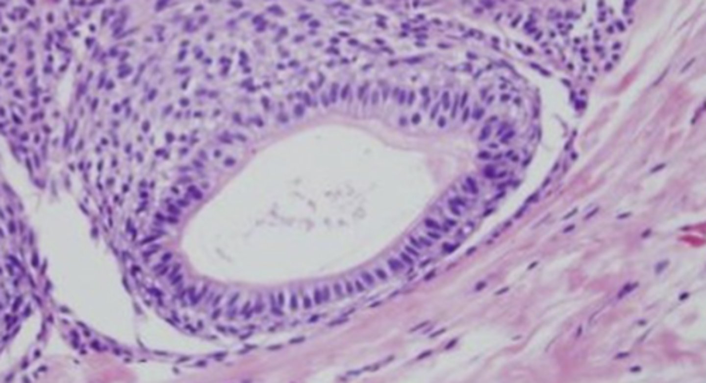 <p>duct-like structures with nuclei polarized away from lumen </p><p>filled with amyloid and may have calcifications</p>