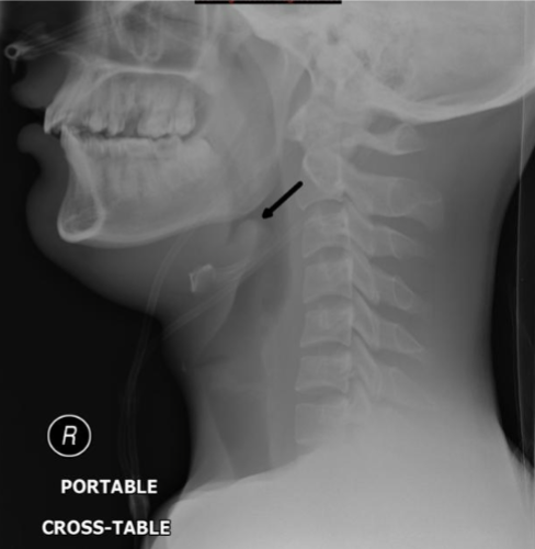 <p><u>Definition</u>: inflammation of the epiglottis</p><p><u>Causes</u>: infectious (H influenza type B, group A B-hemolytic Strep, TB) or inflammatory (sarcoidosis)</p>