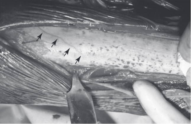 <ul><li><p><span>Plate and screws can be placed from either medial or lateral side but lateral approach has advantages</span></p><ul><li><p><span>Operated limb is uppermost and a lateral plate is easier to remove under local anesthesia in the standing horse after the fracture has healed</span></p></li></ul></li><li><p><span>Dorsolateral or dorsomedial incision made in one layer down to the level of the bone surface</span></p></li><li><p><span>Periosteum may be elevated to expose the surface of the bone so the fracture line or lines can be clearly identified</span></p></li><li><p><span>Incision is continued distad to the level of the joint capsule but the capsule is not incised</span></p></li><li><p><span>Distal two screws placed through stab incisions using radiographic control, similar to nondisplaced lateral condylar fractures</span></p></li><li><p><span>Broad DCP or LCP is positioned on the lateral aspect of the bone extending from just above the second screw to the most proximal portion of the bone</span></p><ul><li><p><span>Typically 10-12 hole plates in MCIII and 12-14 hole plates in MTIII</span></p></li><li><p><span>Can spirally contour the plate if the specific configuration of the fracture is evident but a straight plate can usually be safely applied in nondisplaced fractures</span></p></li></ul></li><li><p><span>Exposure of the diaphyseal bone surface allows accurate placement of additional screws across the fracture plane and centrally within the fracture fragment</span></p><ul><li><p><span>4.5 or 5.5 mm cortex screws used</span></p></li></ul></li><li><p><span>Inadvertent injury to the suspensory ligament, splint bones, or both can occur</span></p><ul><li><p><span>Obliquely directed screws or DP directed screws are drilled with care</span></p></li></ul></li><li><p><span>If special recovery systems are not available, a full-length hindlimb case should be considered for metatarsal fractures</span></p></li><li><p><span>Forelimb medial condylar fractures are usually recovered in a full-limb Robert Jones bandage</span></p></li></ul>