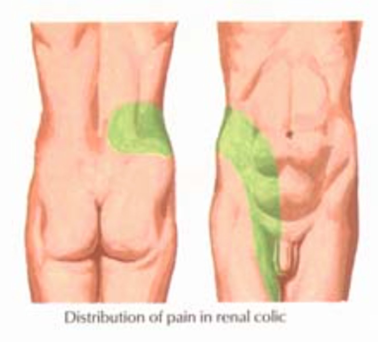 <p>pain (renal colic ; flank pain-&gt; groin), usually unilateral</p>