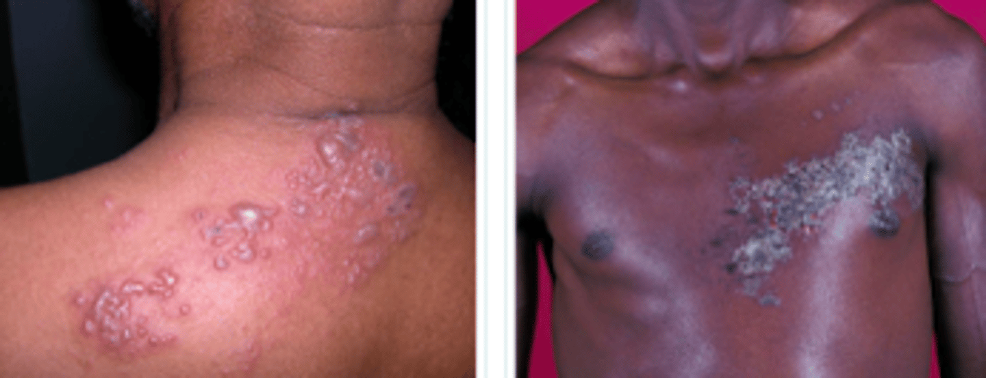 <p>Viral Skin Infections:</p><p>- active dermatomal infection associated w the <strong>reactivation of varicella zoster virus</strong></p><p>- characterized by <strong>unilateral pain</strong> &amp; a v<strong>esicular eruptio</strong>n l<strong>imited to a dermatome innervated by a corresponding sensory ganglia</strong></p><p>- can ONLY occur in someone that has previously had chicken pox (<strong>&gt;50)</strong></p><p><strong>Prodrome: </strong>Neurotic pain or paresthesia for 2-3 weeks prior. <strong>Allodynia</strong>: Heightened sensation to mild sensation</p>