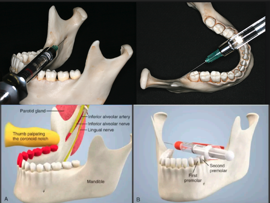 <p>which injection technique?</p>