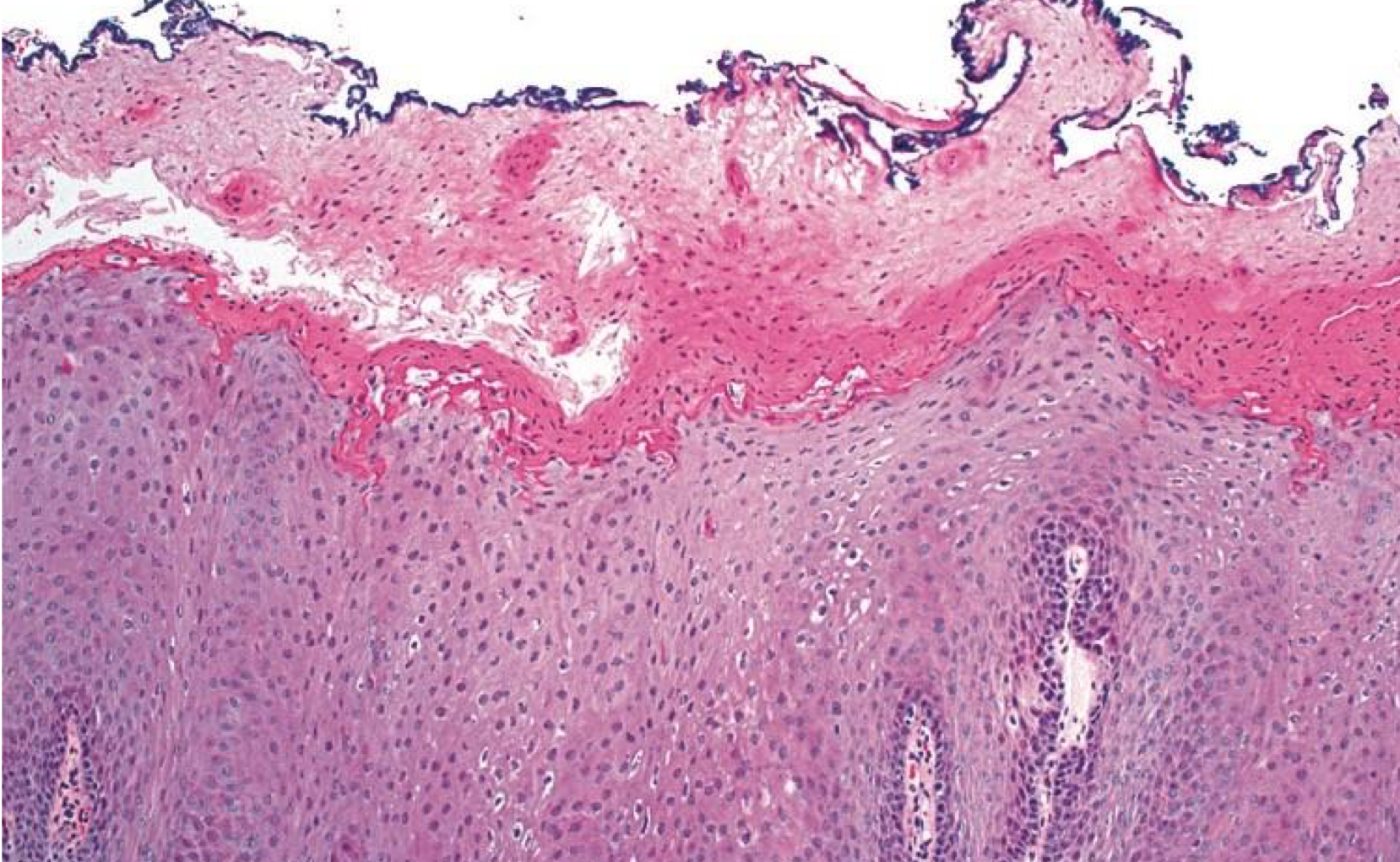 <p>which environmental/reactive lesion: morsicatio buccarum</p><p>increased parakeratin → protective and acantosis make lesion white </p>
