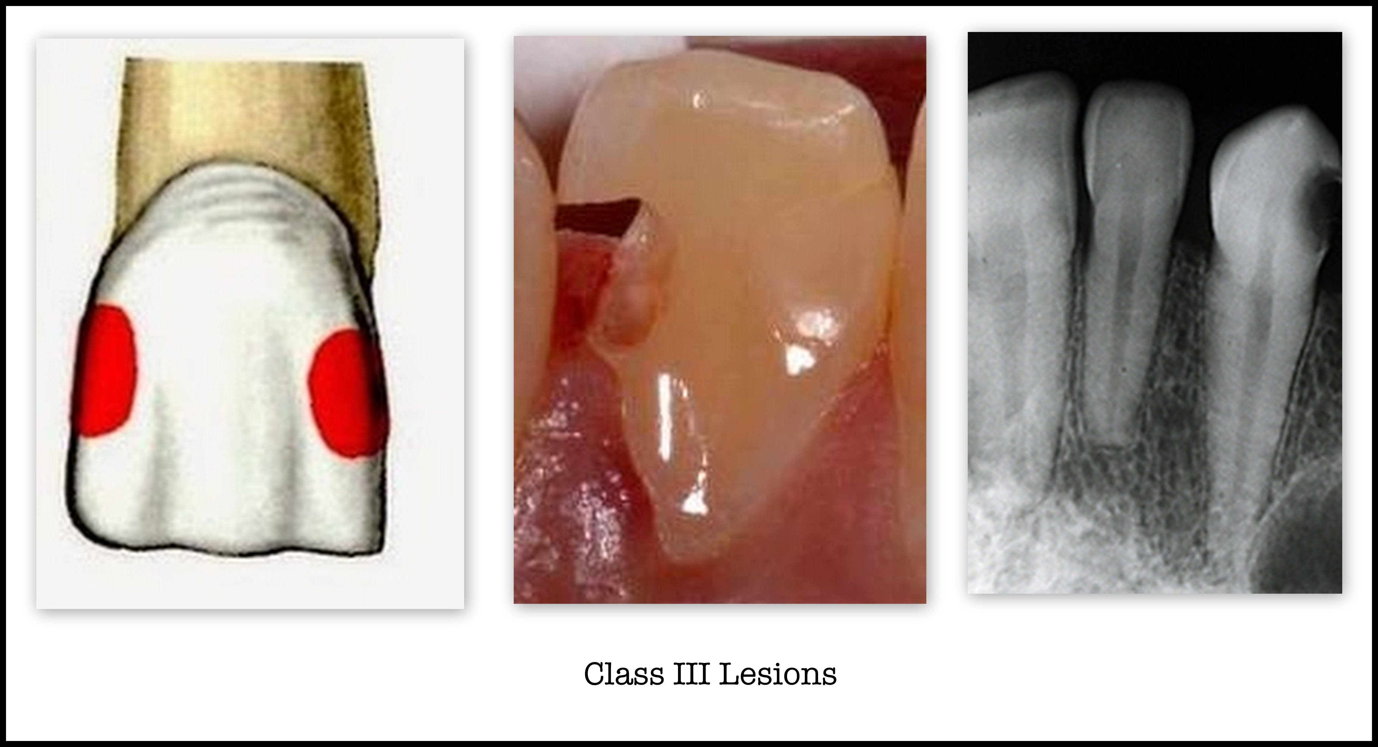 <p>Interproximal surfaces</p><p>of anterior teeth without</p><p>Incisal edge involevement</p>