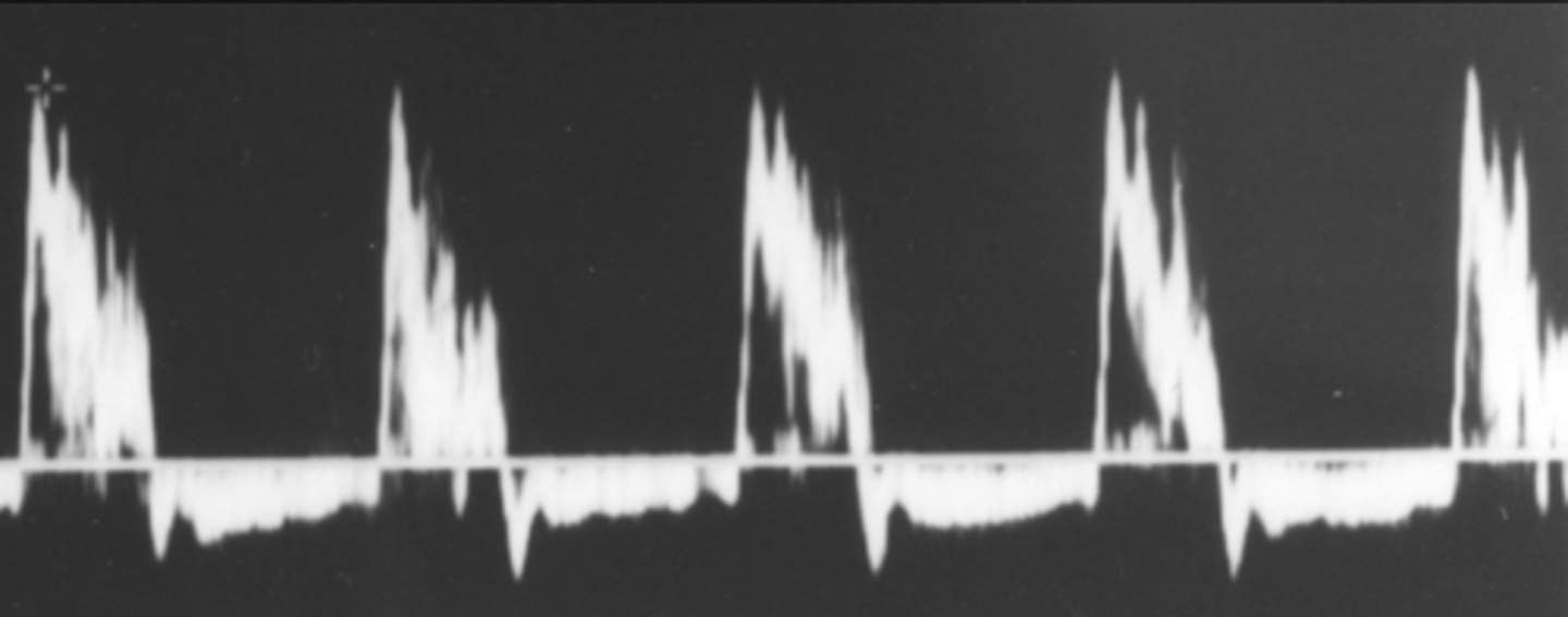 <p>Proximal hammer pulse</p><p>Minimal thrill</p><p>Lack of venous distention</p><p>Lack of high-pitched bruit</p><p>Signs of stenosis &amp; palpable distal thickening</p>
