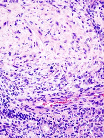 <p><span>•Benign tumor</span></p><p><span>•Rather common</span></p><p><span>•Composed of</span></p><p><span>–Ductal cells</span></p><p><span>–Myoepithelial cells</span></p><p></p>