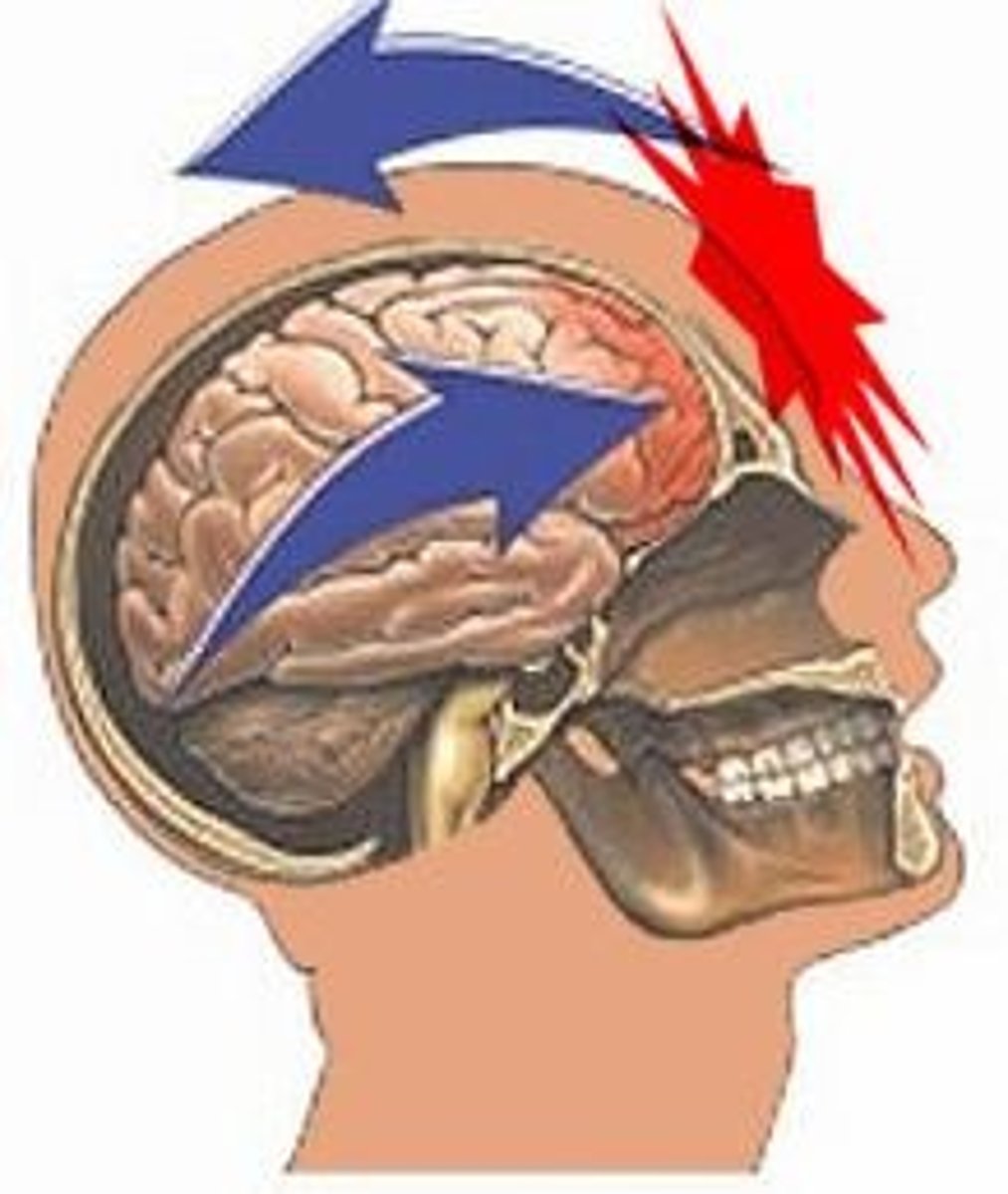 <p>A brain injury in which tissue destruction occurs and does not regenerate</p>
