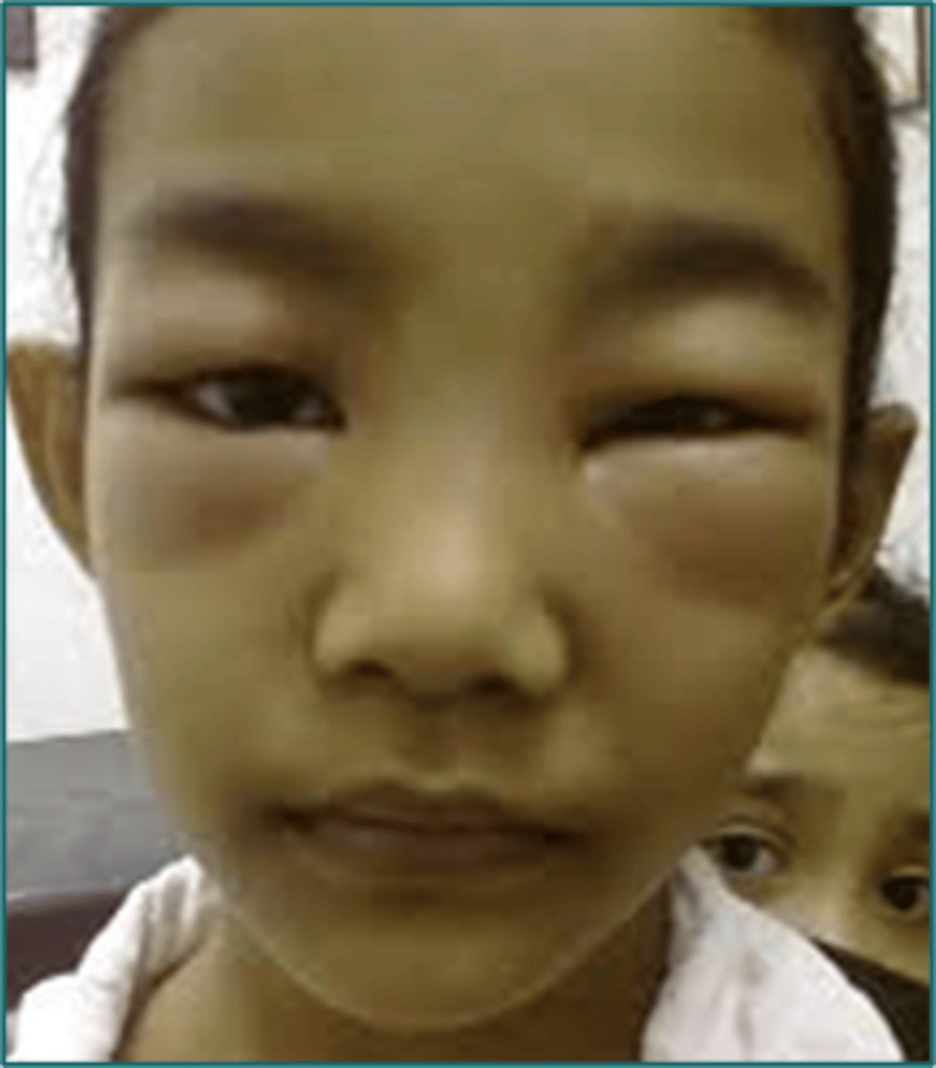 <p>swelling around the eyes</p>