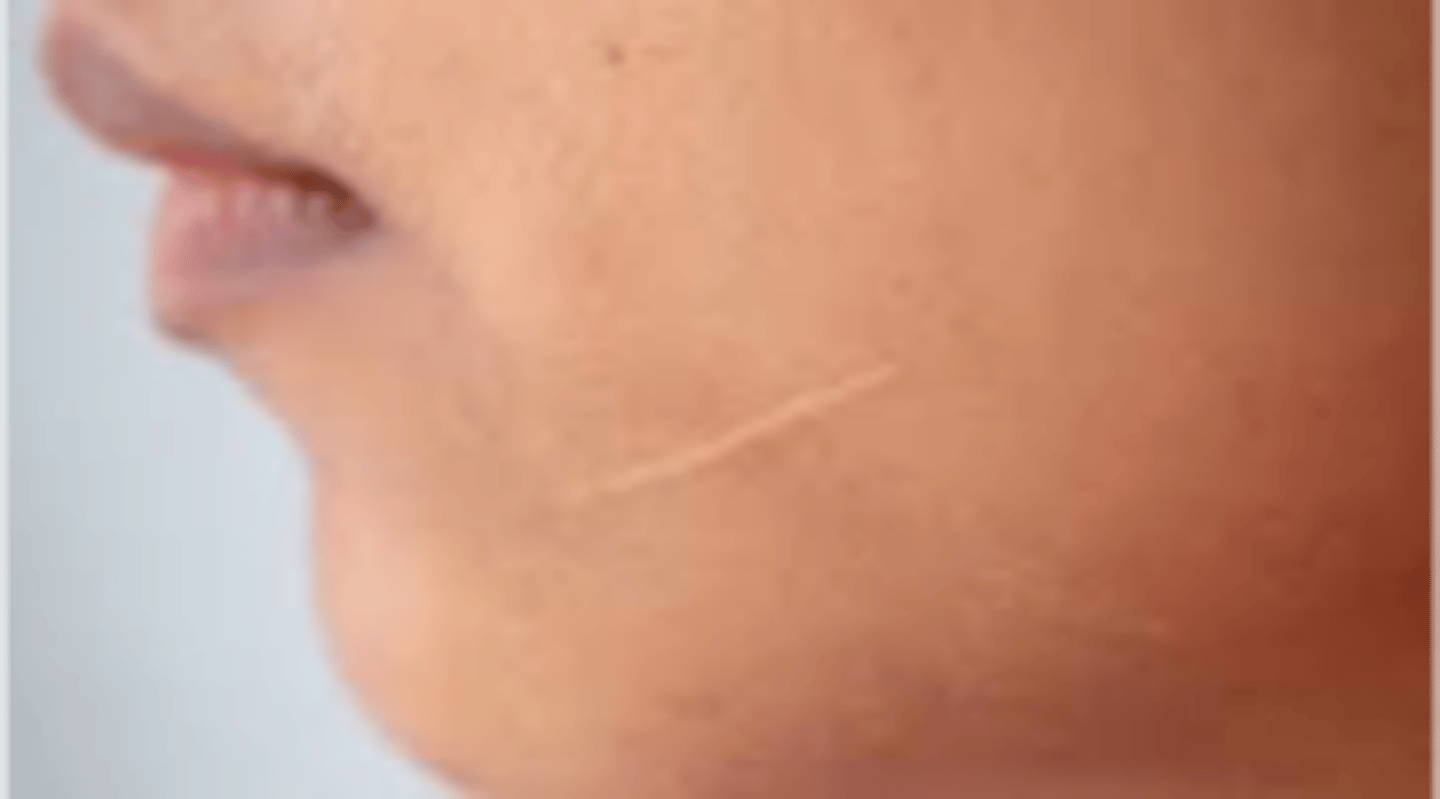 <p>Replacement of destroyed tissue with a more fibrous tissue</p>