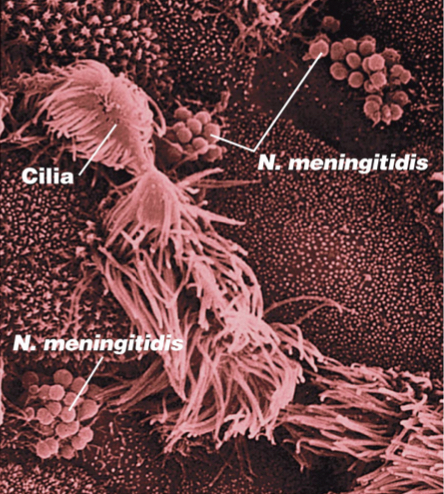 *Neisseria meningitidis* Meningitis