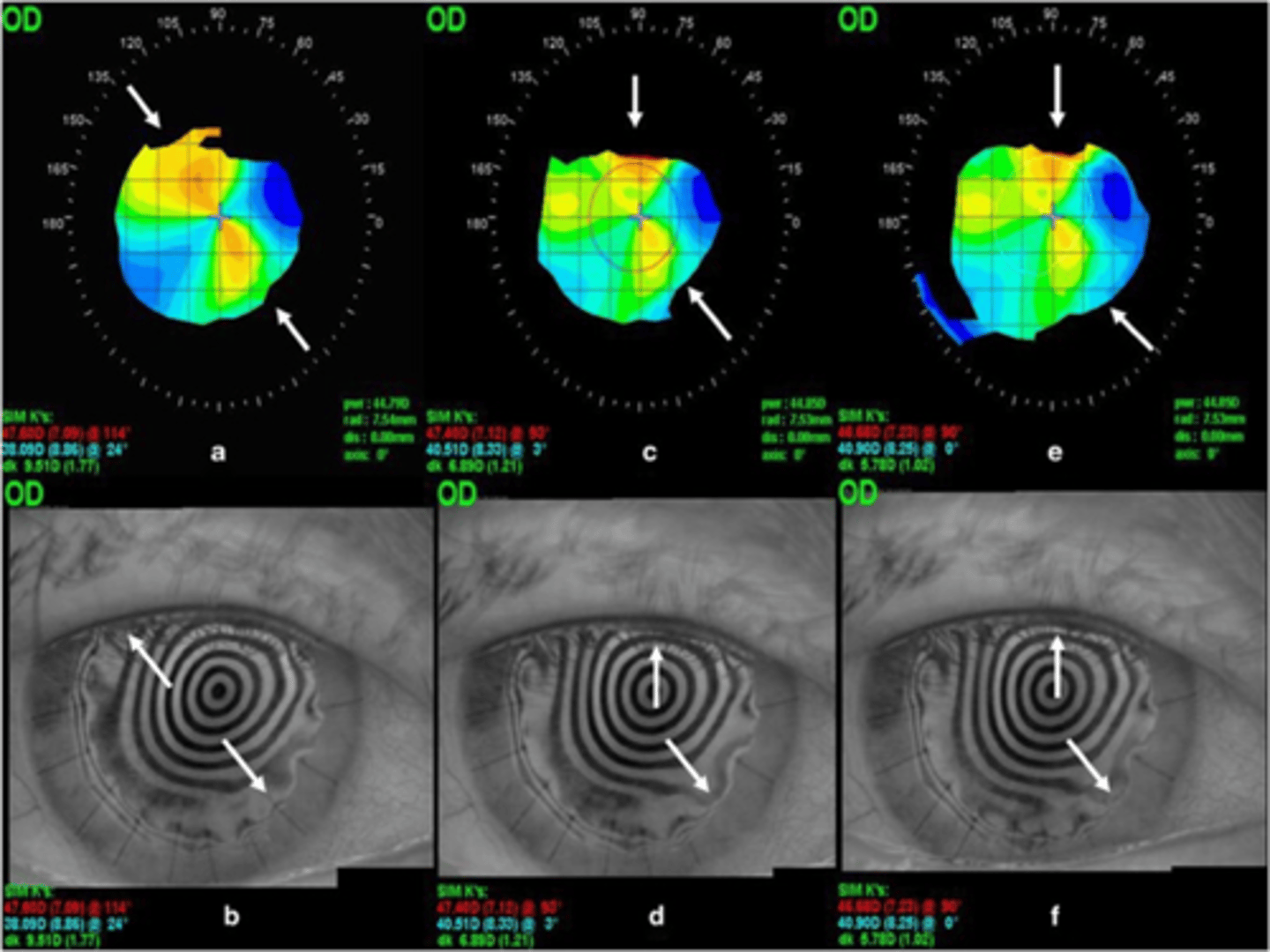 <p>15-31% of post-PK patients will develop at least how much astigmatism?</p>