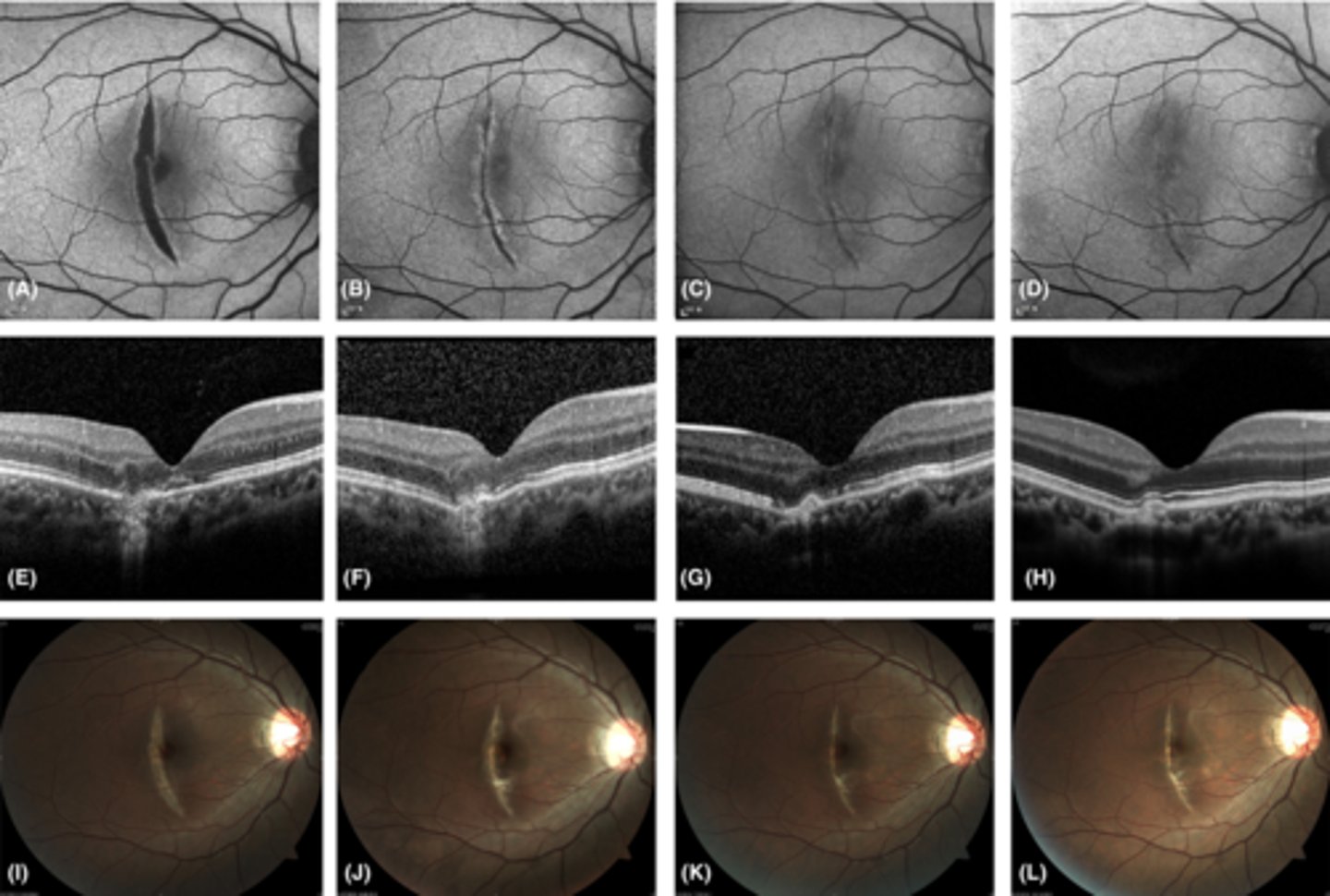 <p>hypoAF where RPE is atrophied</p>