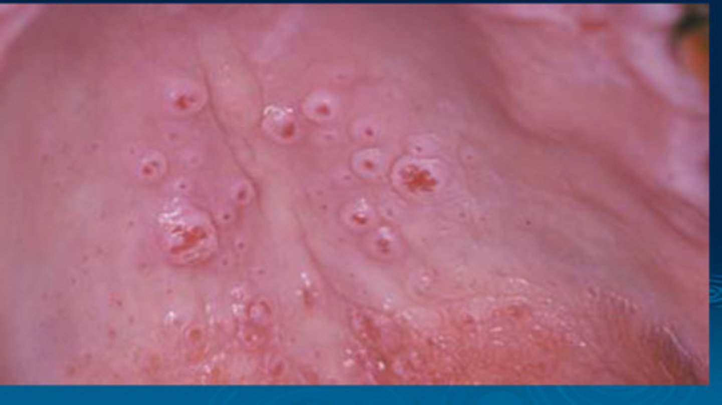 <p>round white lesion + small red dot in center (inflamed salivary gland)</p><p>• pipe/cigar use </p><p>• common location: hard palate</p>