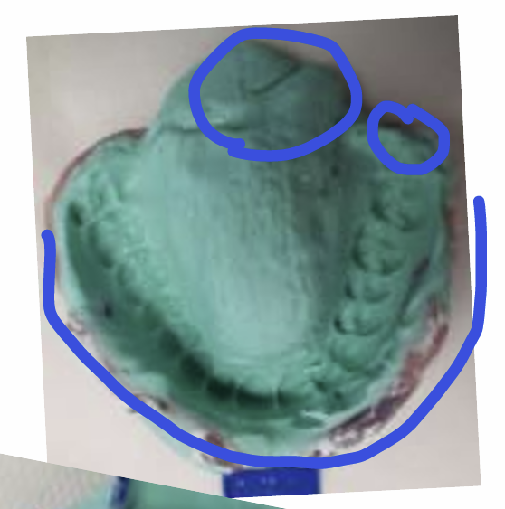 <p>not enough alginate in the tray in the right place - too much at the back but not enough around the border area so most of the border is recorded in wax and not alginate</p><p>lost distal part of the molar </p>