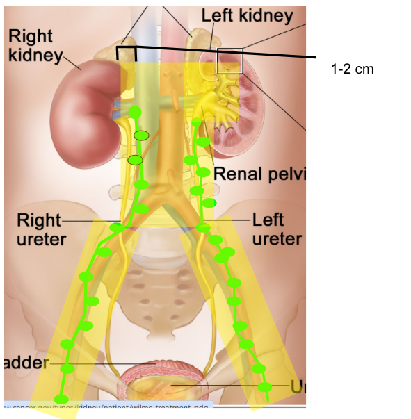 <ol><li><p>What stages is it used on: IV &amp; V sometimes </p></li><li><p>Field Arrangement: Parallel Opposed APPA</p></li><li><p>Organs to avoid: APPA to avoid contralateral kidney </p></li><li><p>Stuff in the field:</p><ol><li><p>tumor bed</p></li><li><p>entire width of vertebral body + 1-2 cm</p></li><li><p>Para-aortic nodes</p></li></ol></li><li><p>Dosage: low dose tx→ 1080-2000cGy</p><ol><li><p>180 cGy/ Day starting at day 9</p></li><li><p>Day 0: surgery </p></li></ol></li></ol><p></p>