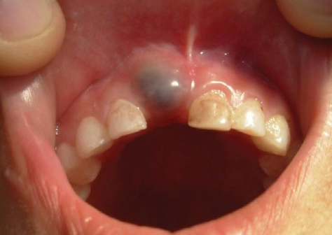 <p>What is an eruption cyst?</p>