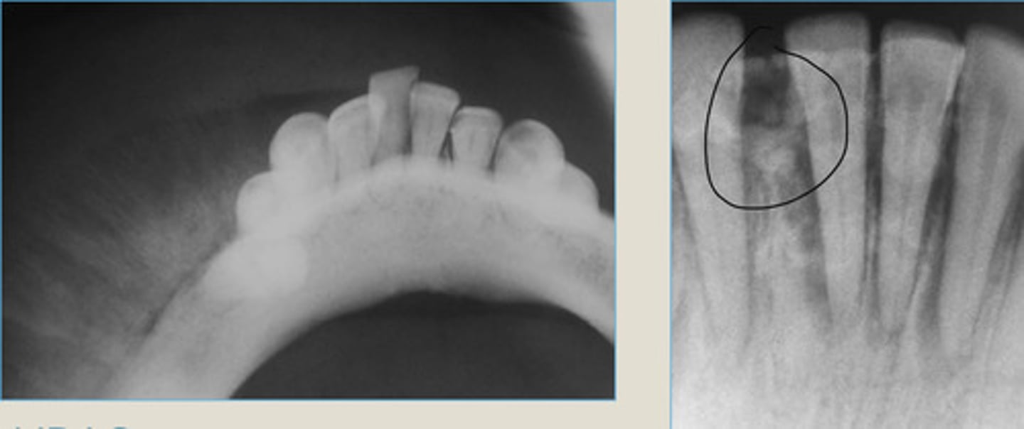 <p>Exophytic tumor bone production resulting in a "sunburst" pattern.</p><p>RIGHT: tumor of the anterior mandible, widening of PDL and mottled radiopacity superimposed on teeth.</p>