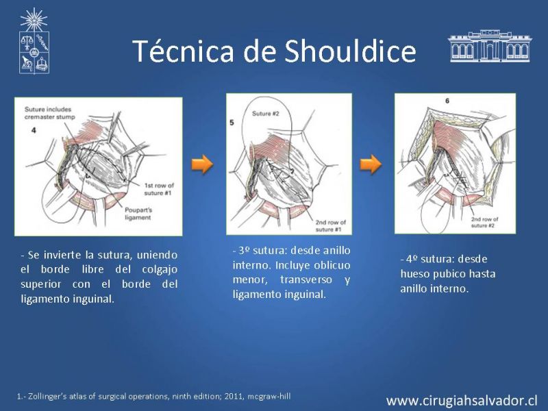 <p>imbricação de 4 planos musculares na parede posterior</p><p>hérnia inguinal</p><p>muita tensão, mas pouco risco de recidiva</p>