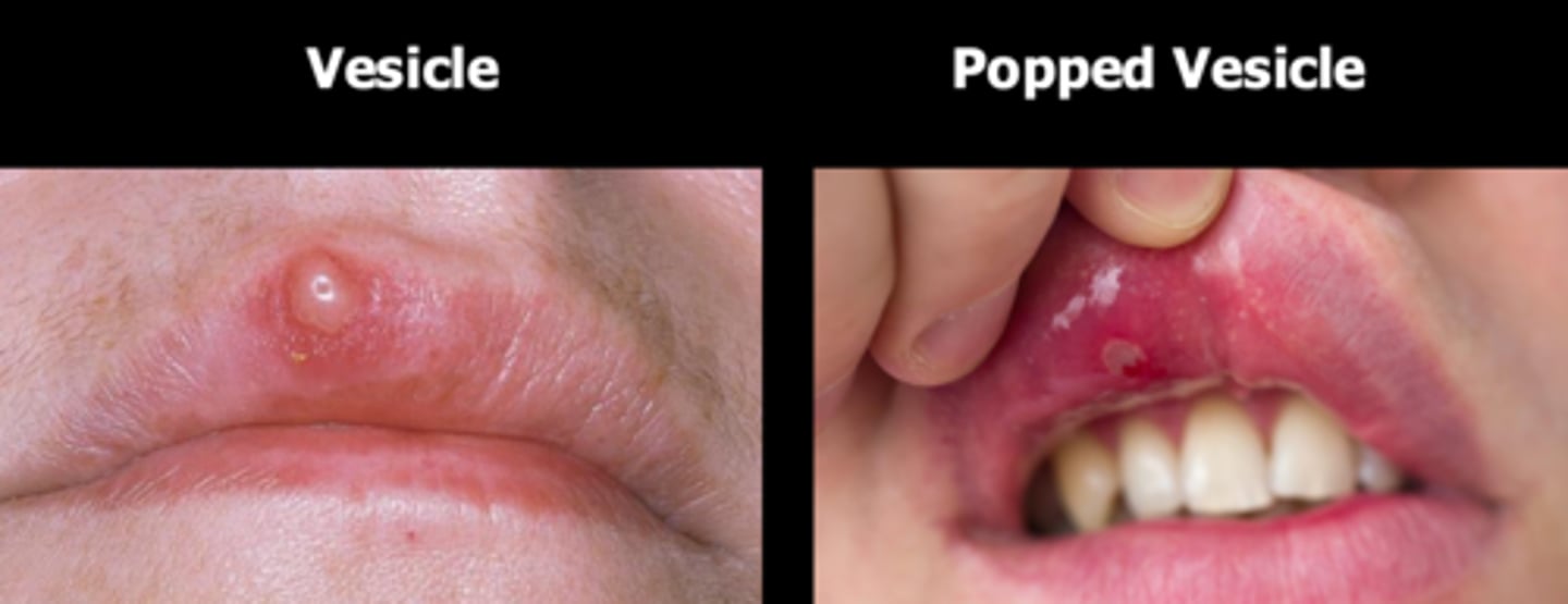 <p>true; presents as an ulcer</p>