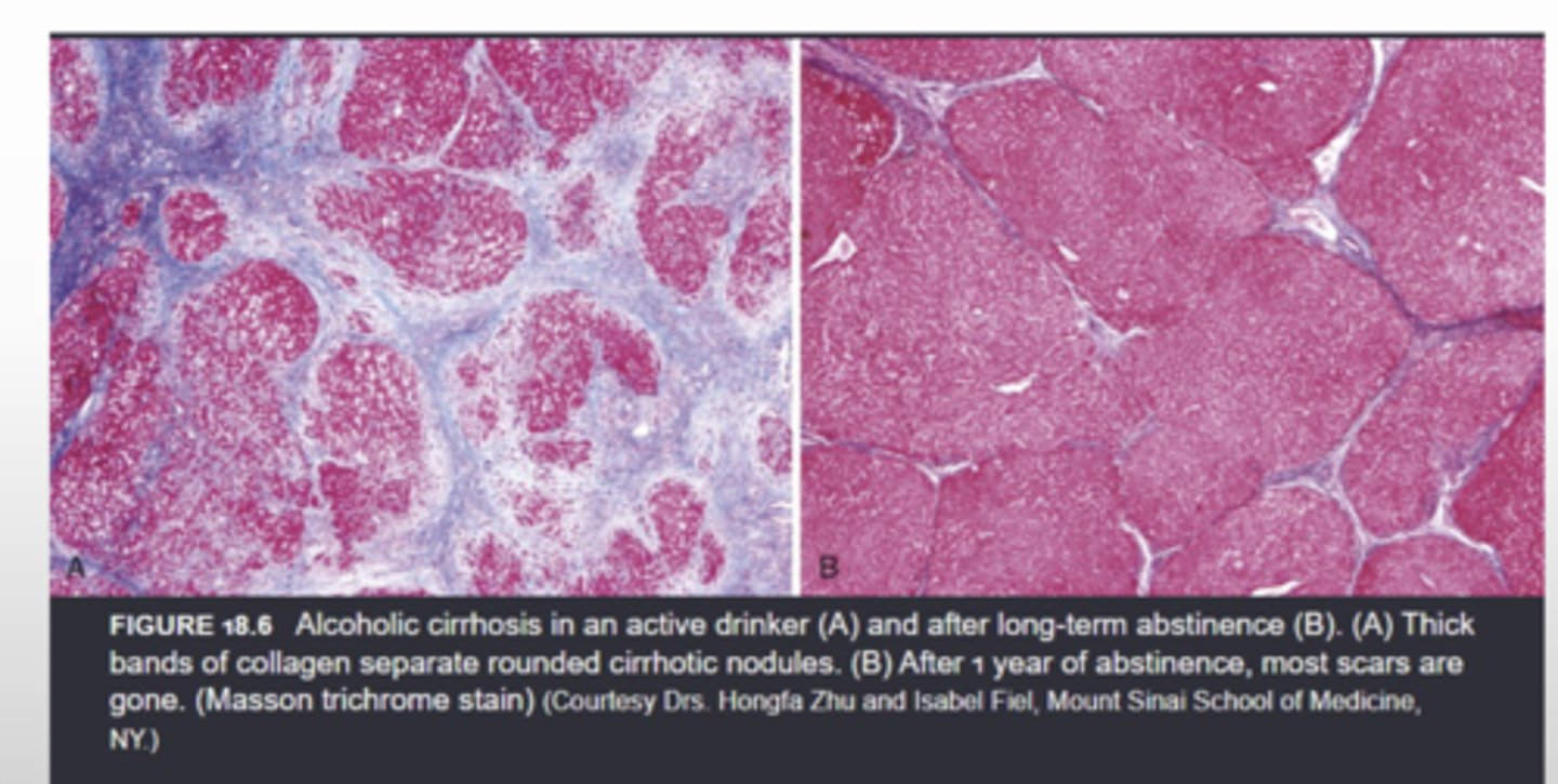 <p>*thick bands of collagen separate rounded cirrhotic nodules</p>