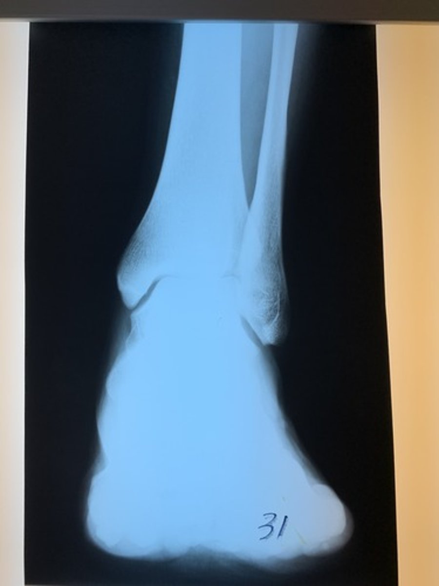 <p>underpenetrated</p><p>2 multiple choice options</p>