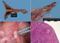 <p>What are the 2 most common congenital conditions of the ovary and give brief description.</p>