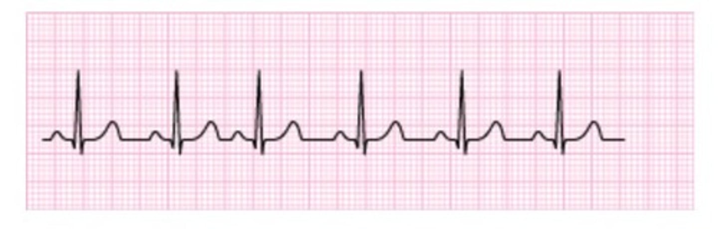 <p>Which of the following arrhythmias is represented in the tracing?</p><p>A) ectopic atrial tachycardia</p><p>B) wandering atrial pacemaker</p><p>C) atrial premature contraction</p><p>D) atrial fibrillation</p>