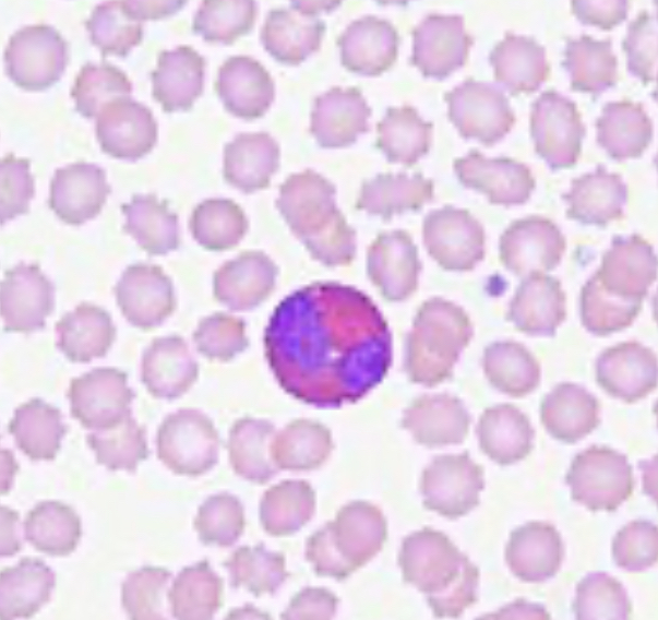 <p>bilobed nucleus (looks like lungs) </p><ul><li><p>2 dark sections in its nucleus </p></li><li><p>has orange/ red granules in the cytoplasm </p></li></ul><p></p>